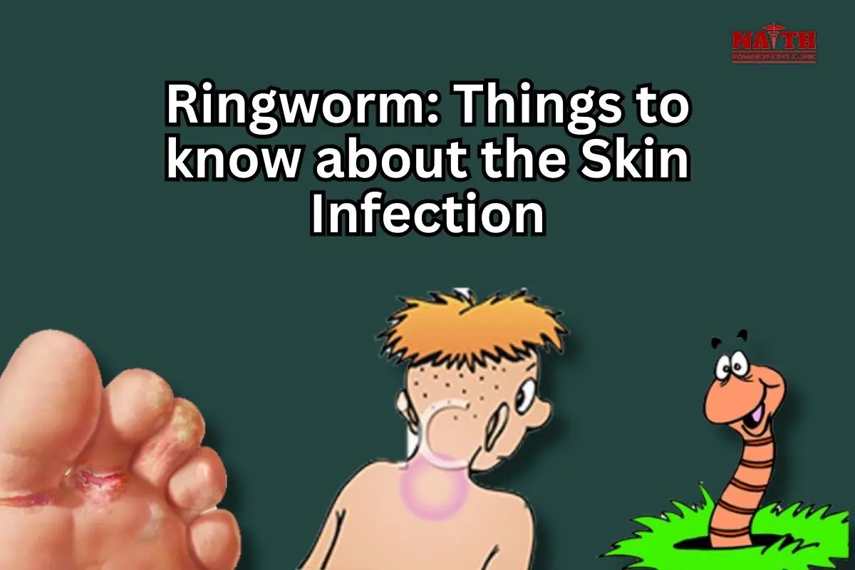 Ringworm: Things to know about the Skin Infection